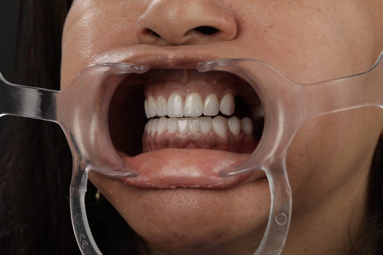 full mouth restoration after