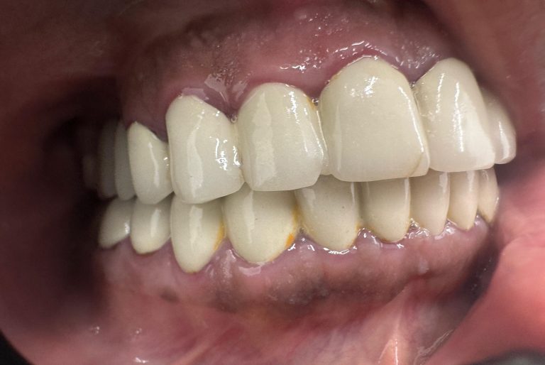 full mouth restoration before v