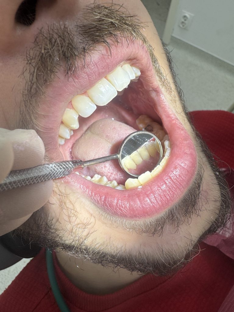 after teeth cleaning (1)