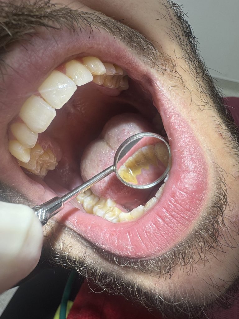 before teeth cleaning (1)