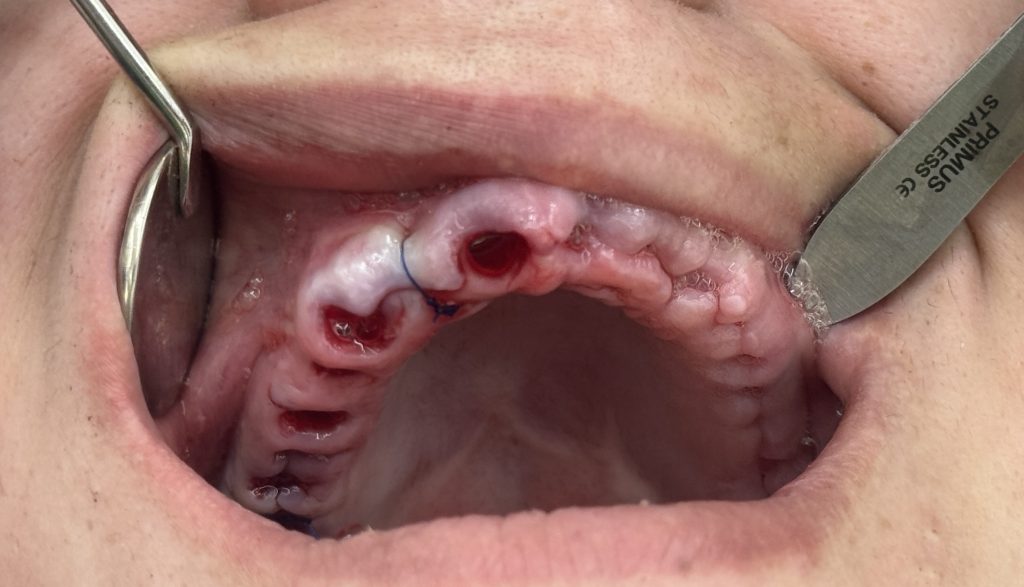 full mouth treatment (1)