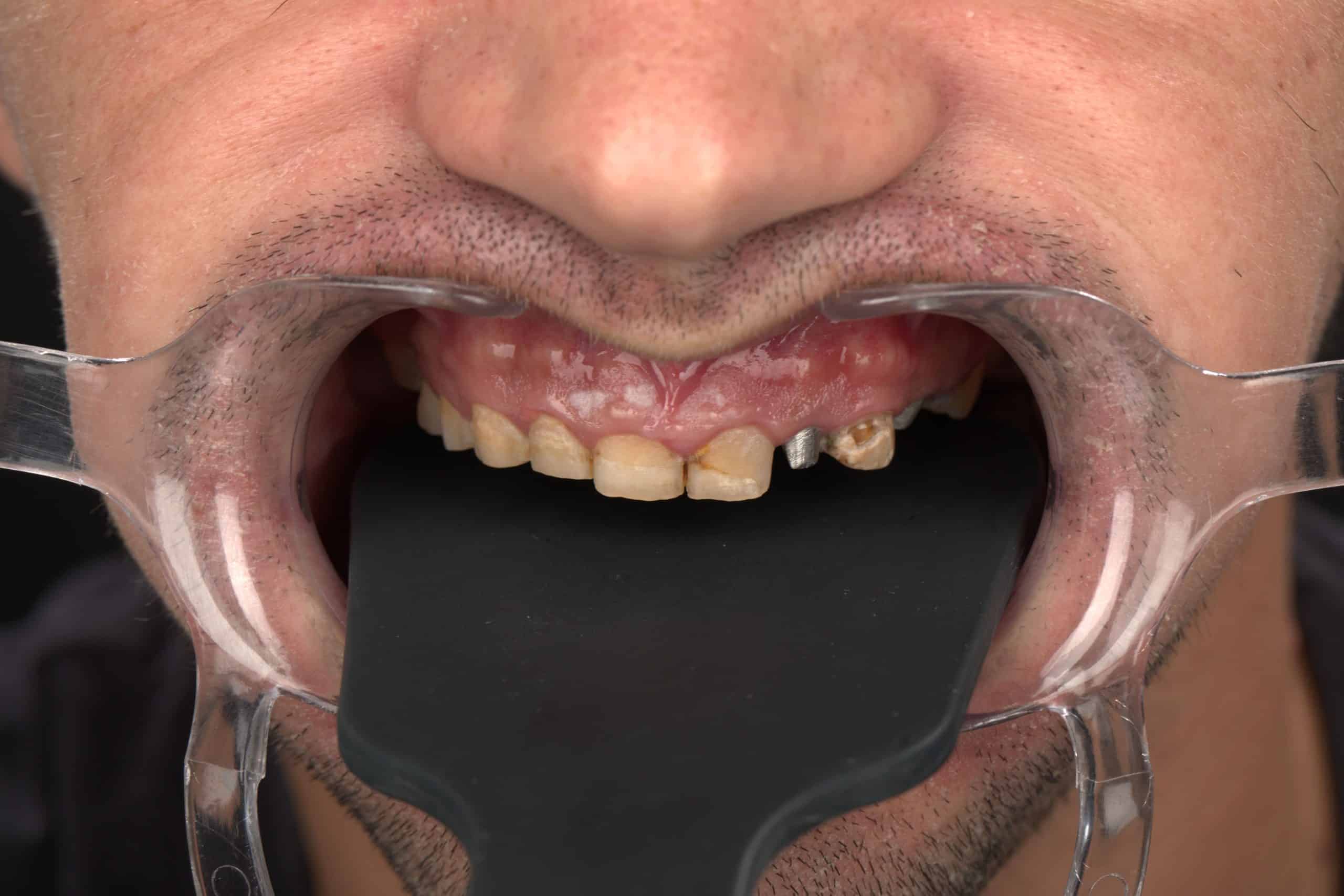 Home Romania Dental Trip before & after images