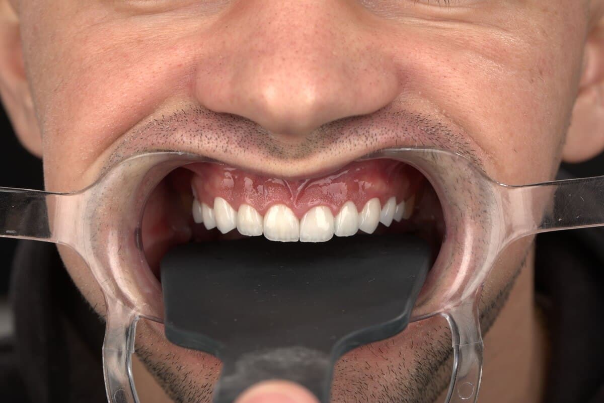 Home romania dental trip after treatment